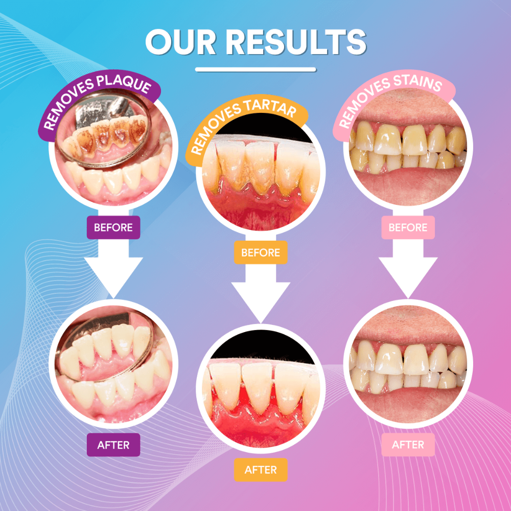 Skorter | Ultrasonic Tooth Cleaner | Advanced Teeth Cleaning Technology