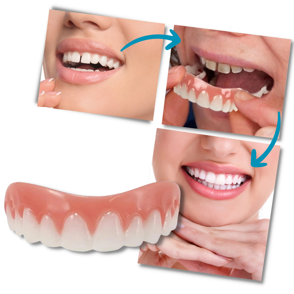 Snap-On Veneer Teeth