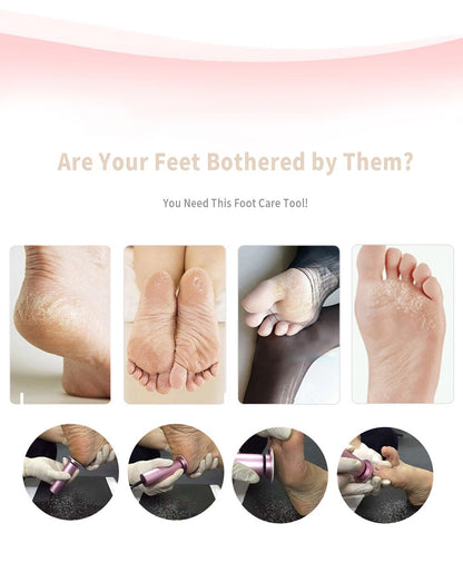 Skorter | Callus Remover - Foot Callus Remover