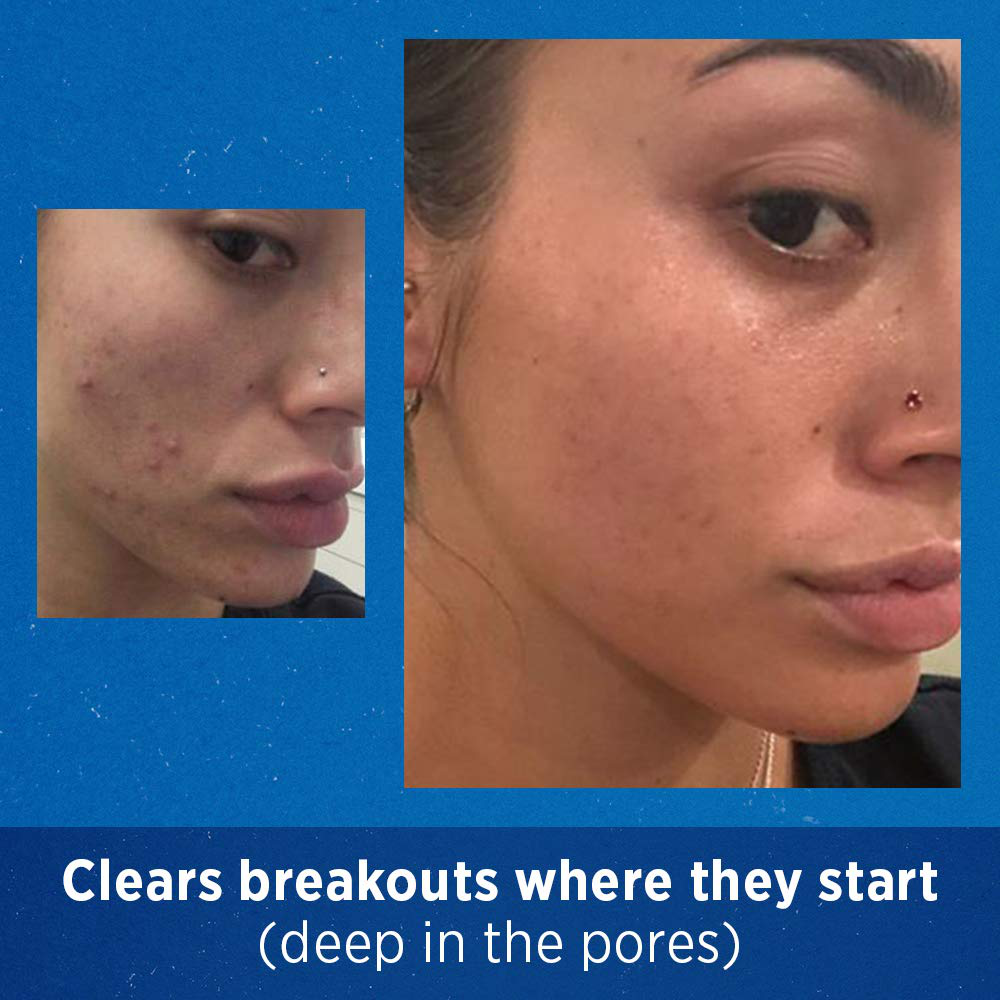 Skorter | Acne Treatment Differin Gel, 60 Days Supply, Retinoid Spot Treatment for Face with 0.1% Adapalene, Gentle Skin Care for Acne-Prone Sensitive Skin, 15g Tube (Pack of 2)