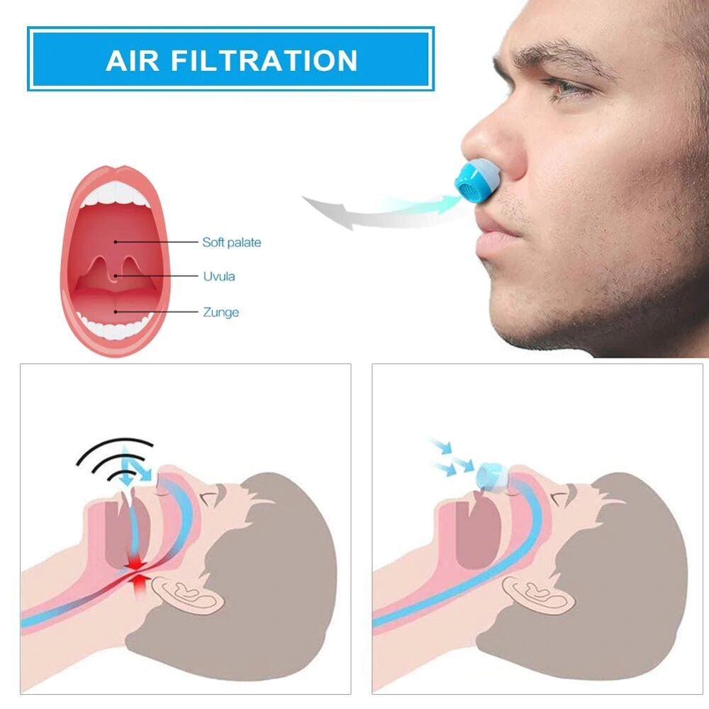 Skorter | Anti-Snoring Device | Tubeless, maskless micro-CPAP