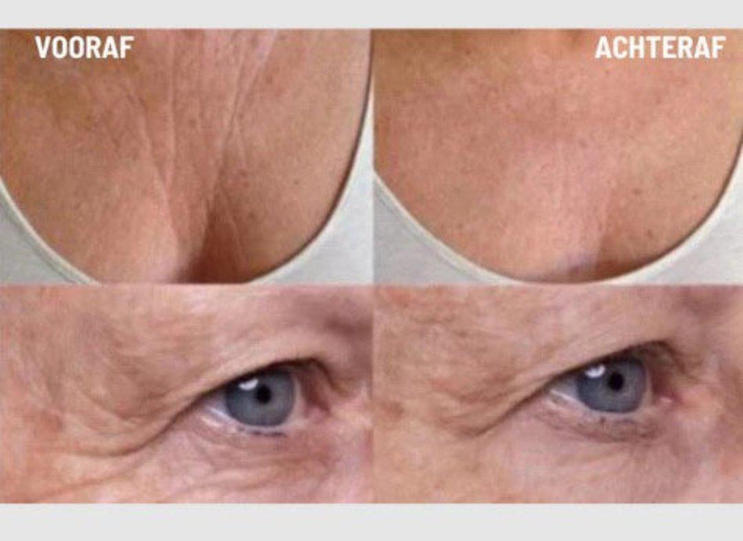 Skorter | Anti-Wrinkle Silicone Pads