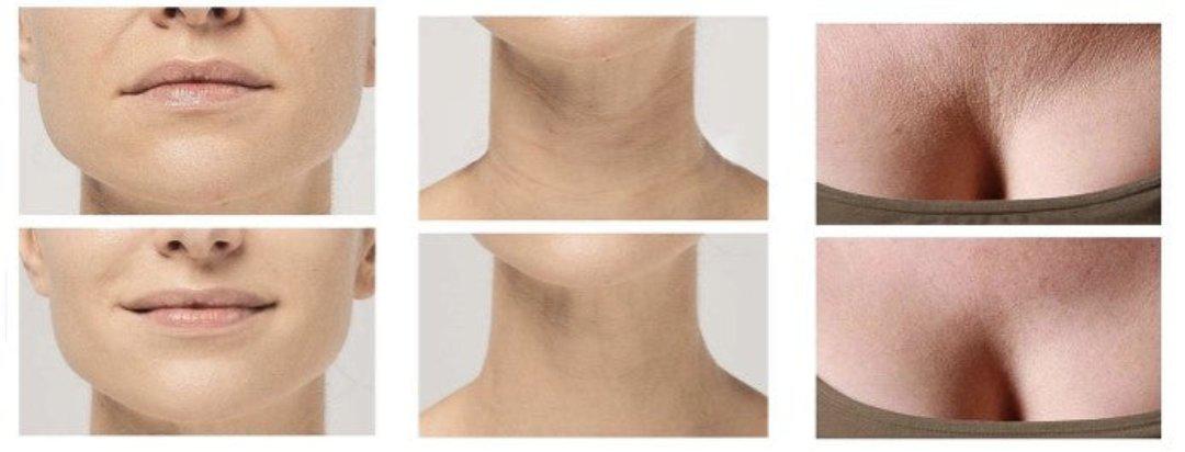 Skorter | Anti-Wrinkle Silicone Pads