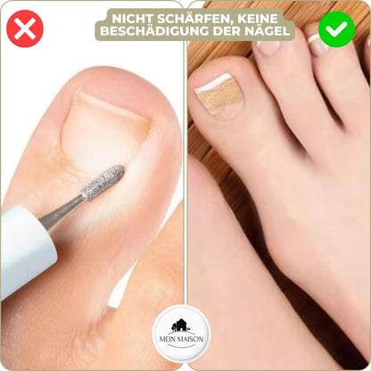 Skorter | FixaNail – Painless nail correction for ingrown & deformed nails