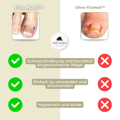 Skorter | FixaNail – Painless nail correction for ingrown & deformed nails