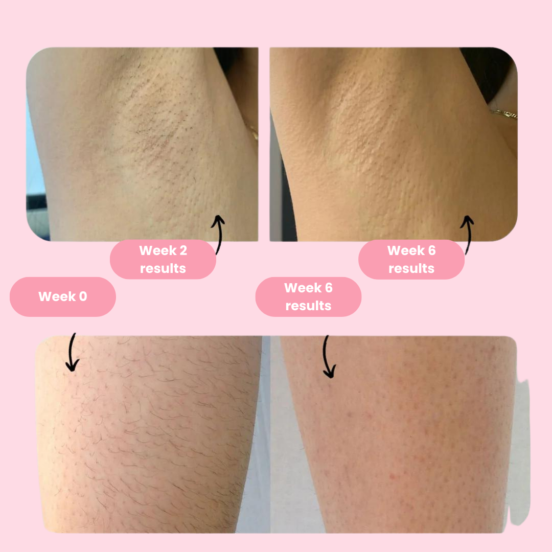 Skorter | IPL Permanent Hair Removal