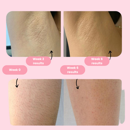 Skorter | IPL Permanent Hair Removal