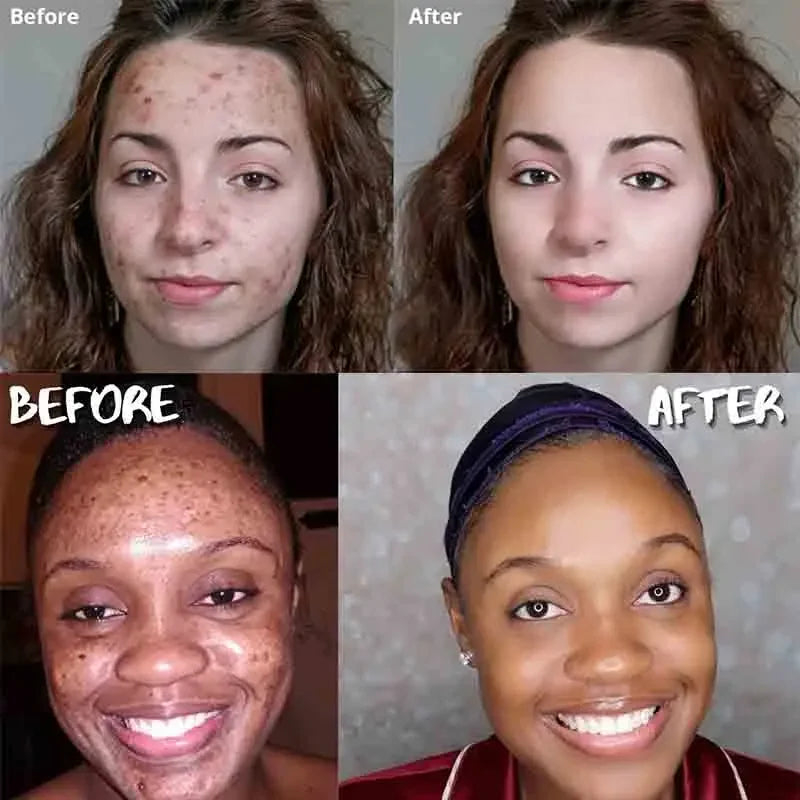 Skorter | Turmeric Soap Facial Cleansing Anti Acne Remove Pimples Dark Spots