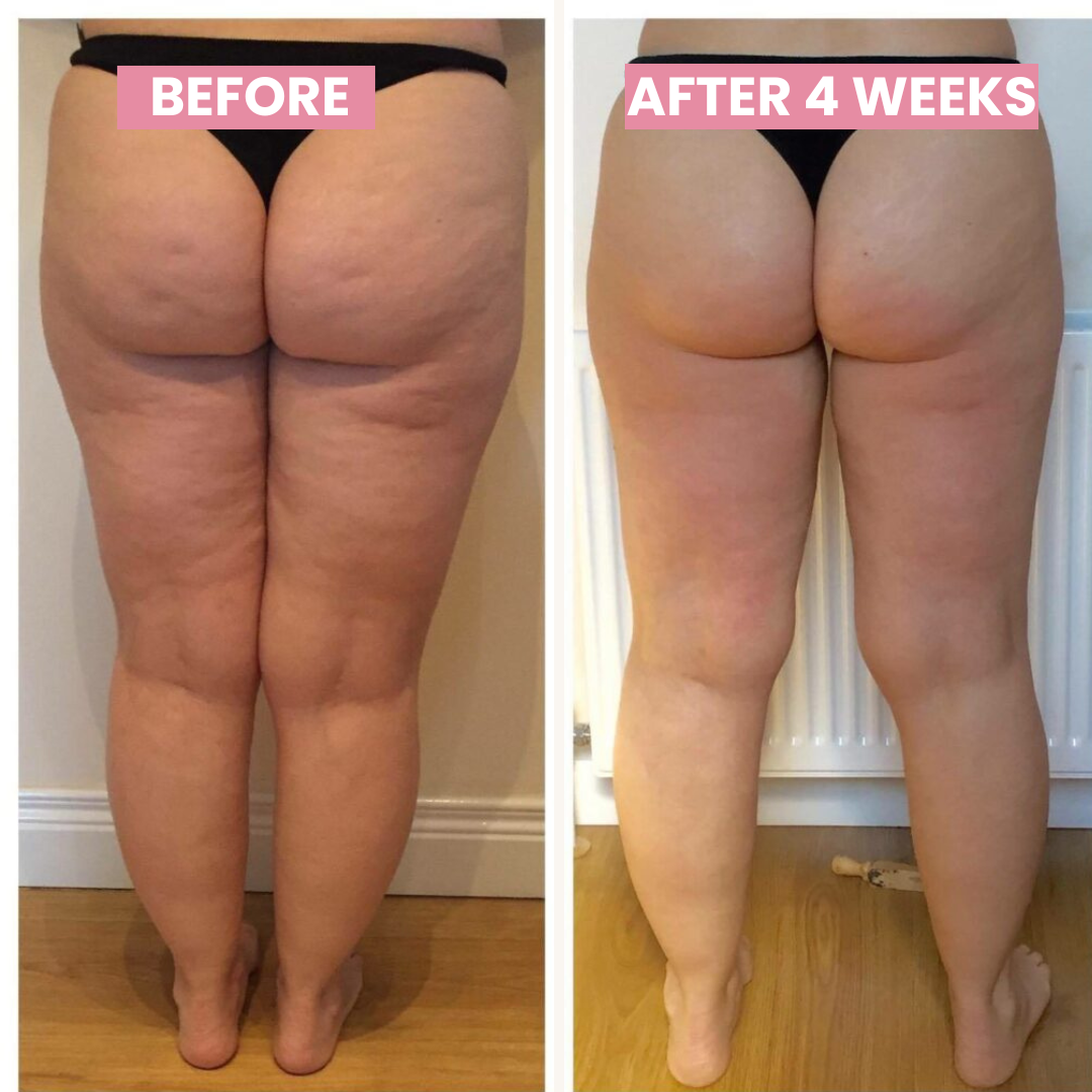 Skorter | Anti-cellulite Cupping Device - SlimCupp