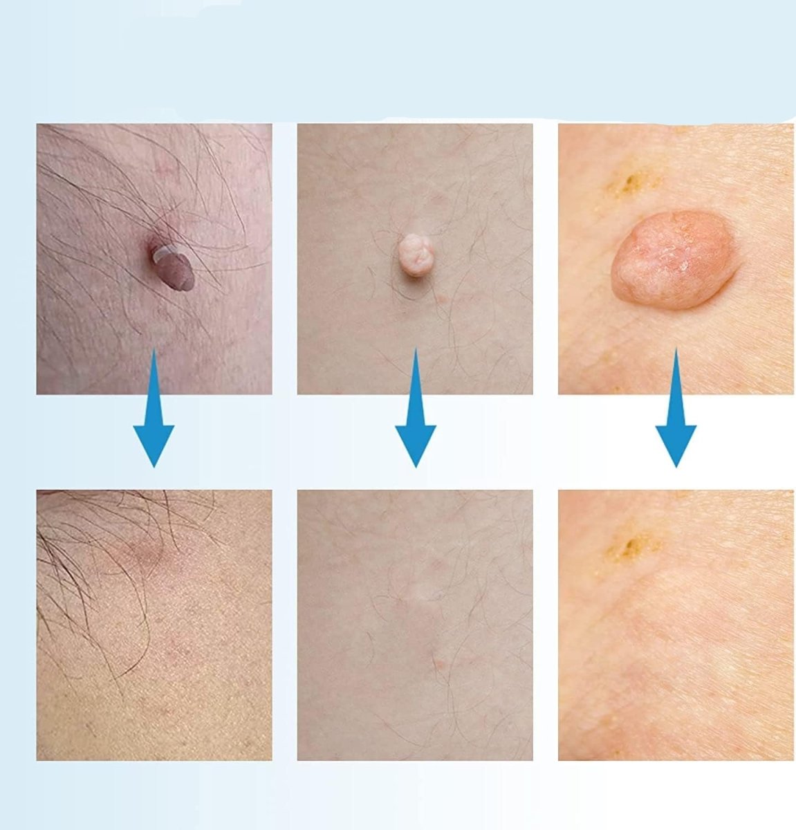 Skorter | EPICLEAR – At-Home Skin Tag & Wart Remover Kit