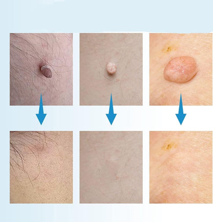 Skorter | EPICLEAR – At-Home Skin Tag & Wart Remover Kit