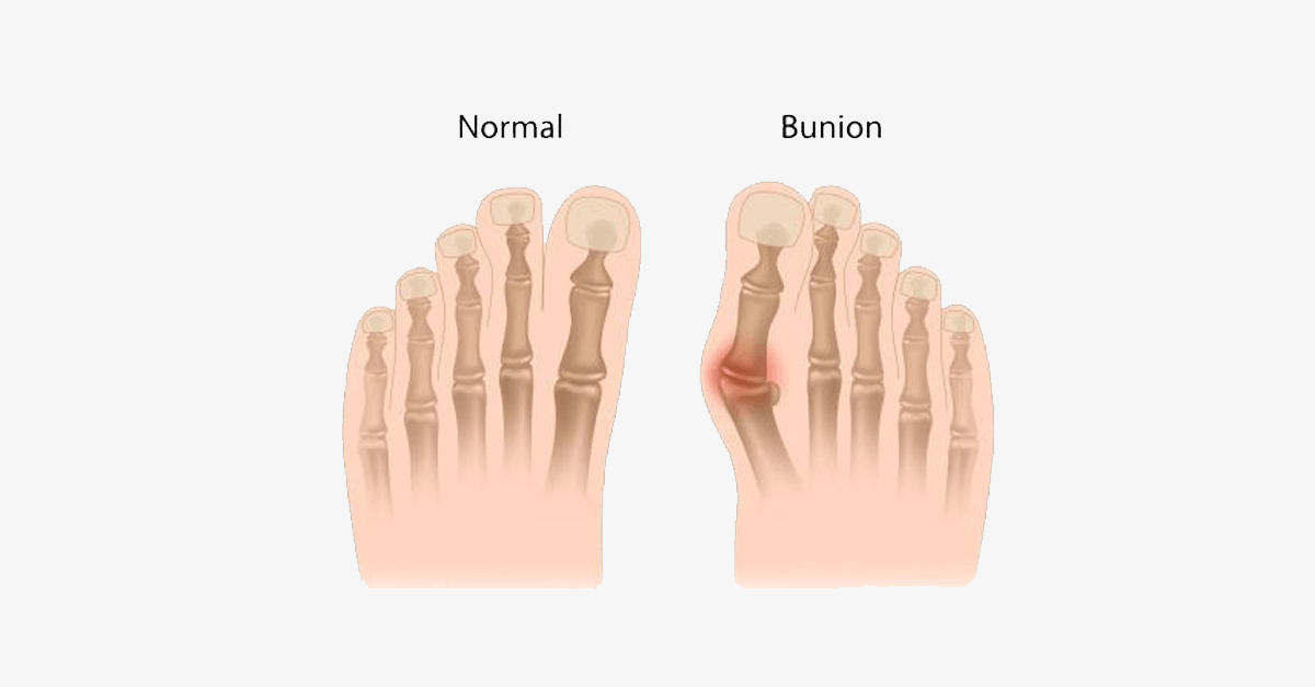 Skorter | Comfort Healing Toe Separators and Hallux Valgus Spacers