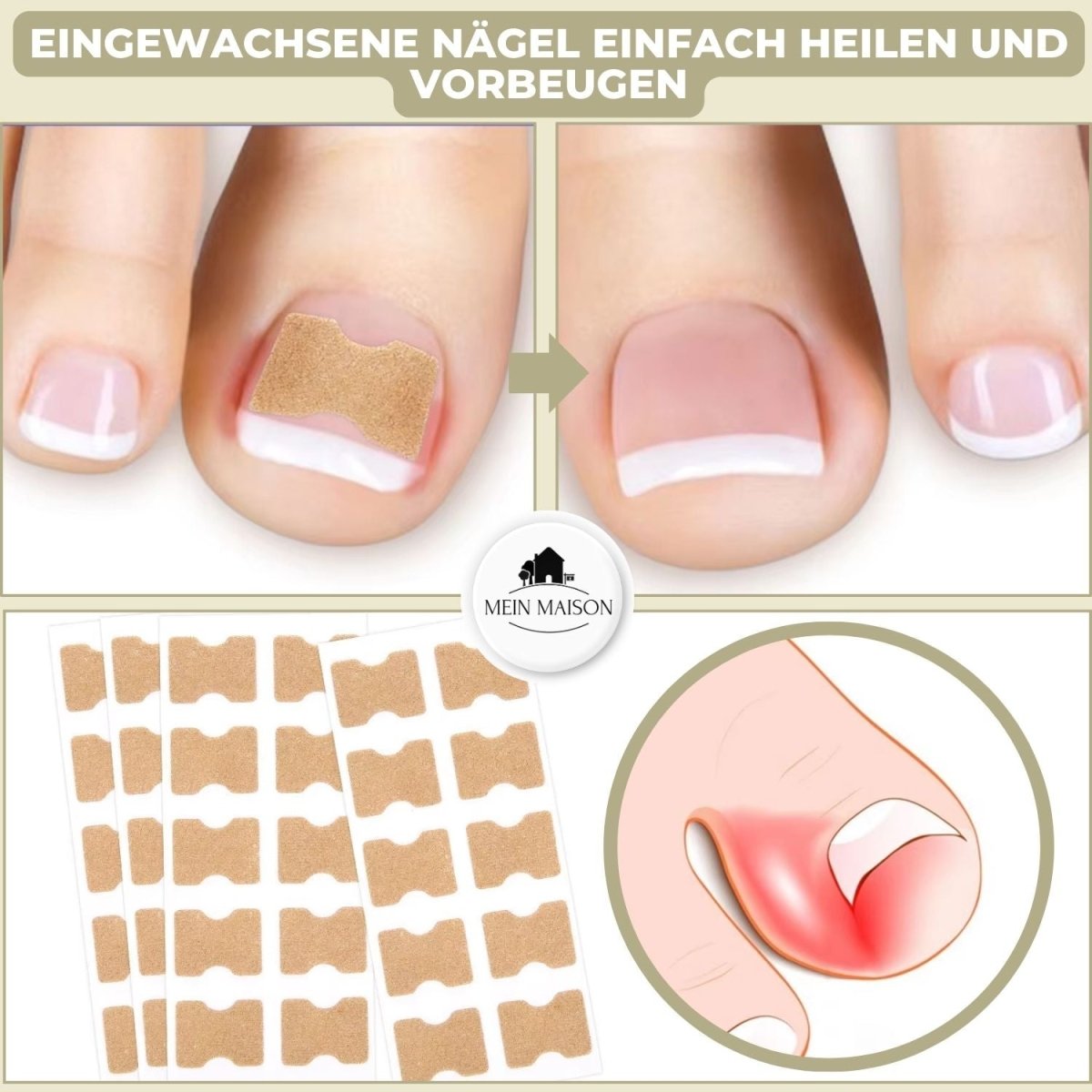 Skorter | ALIGNSTRIP – Painless Nail Correction Strips for Ingrown & Deformed Nails