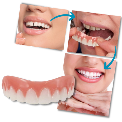 Snap-On Veneer Teeth