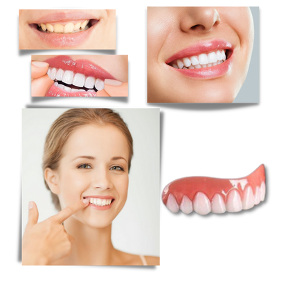 Snap-On Veneer Teeth